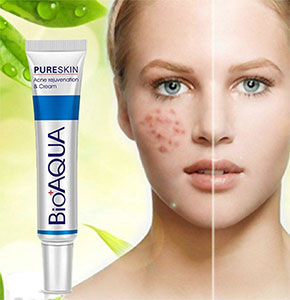 [2542] Women Facial Acne Treatment Removal Cream Spots Scar Blemish Mark For Face